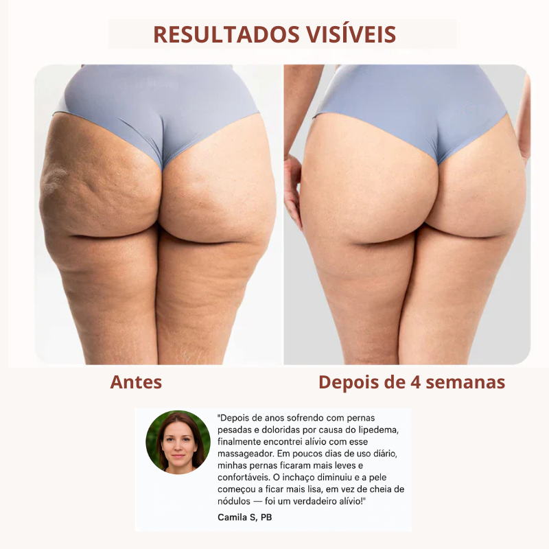 Drena Roller | Massageador linfático para lipedema e celulite
